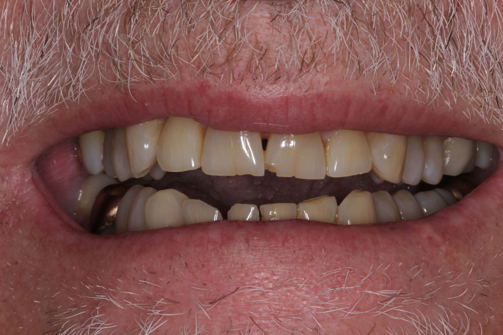 Full mouth makeover before