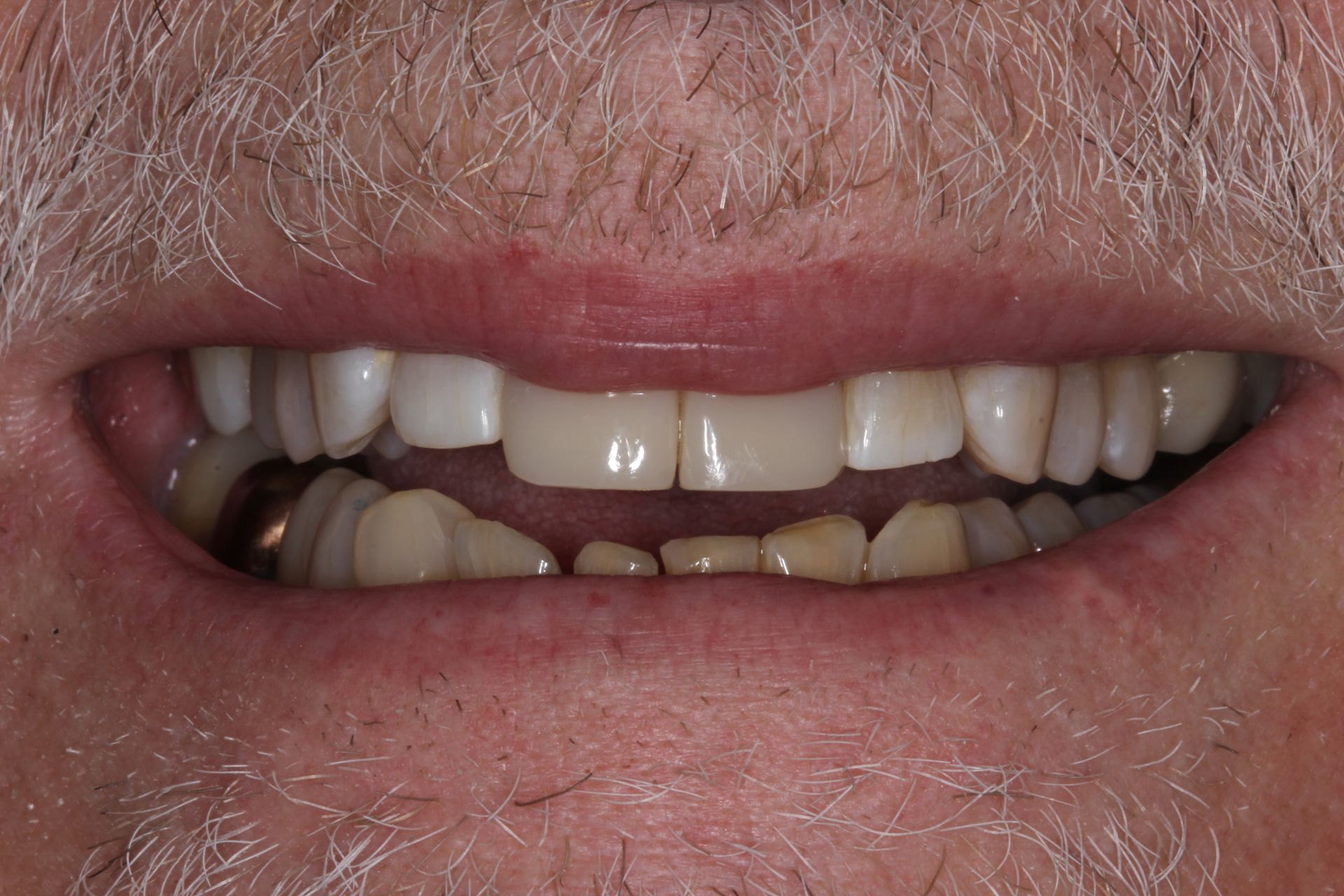 Full mouth makeover after