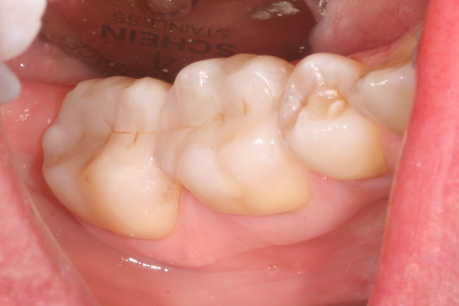 Full mouth makeover after