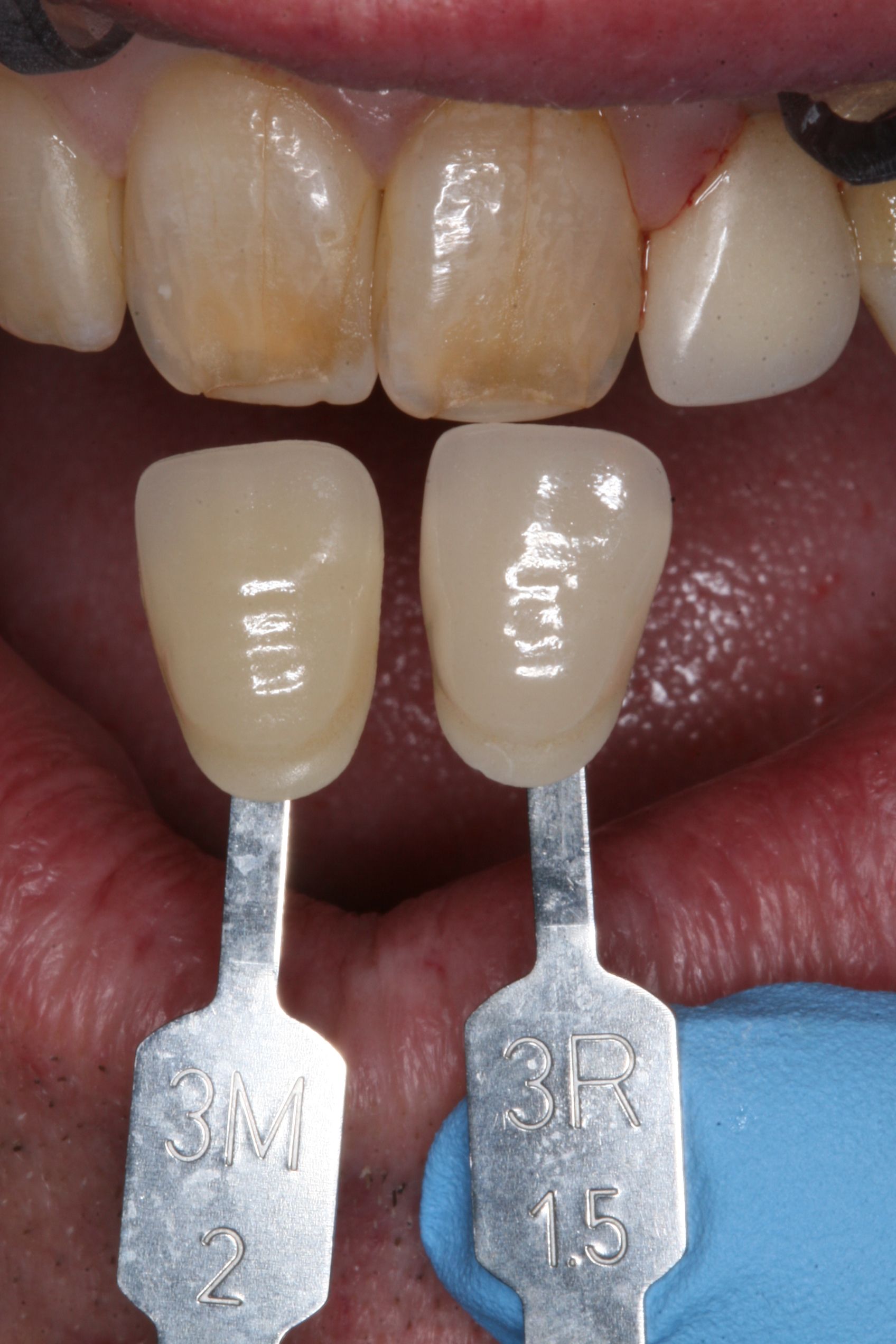 Full mouth makeover before