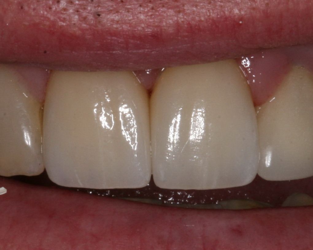 Full mouth makeover after