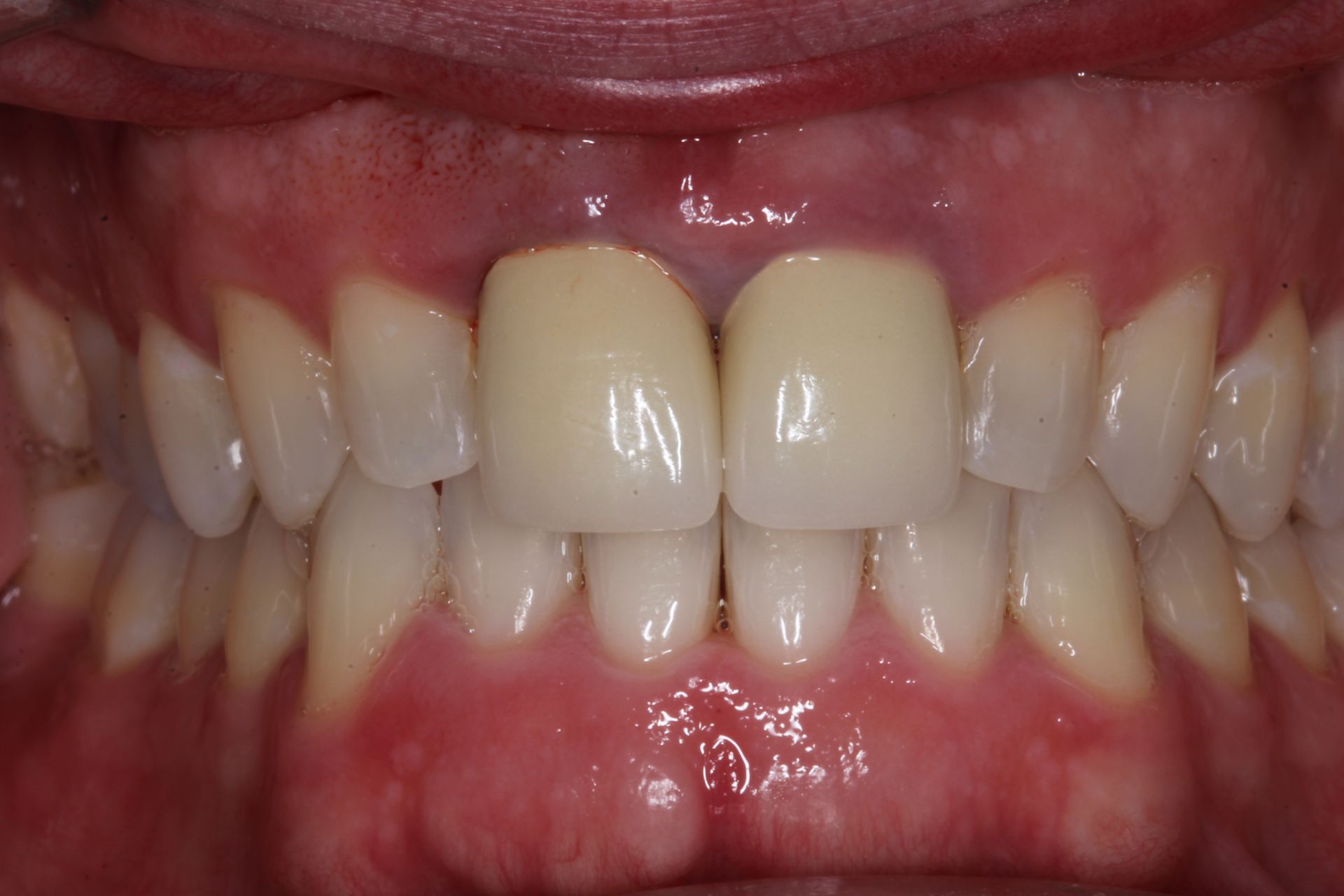 Full mouth makeover before