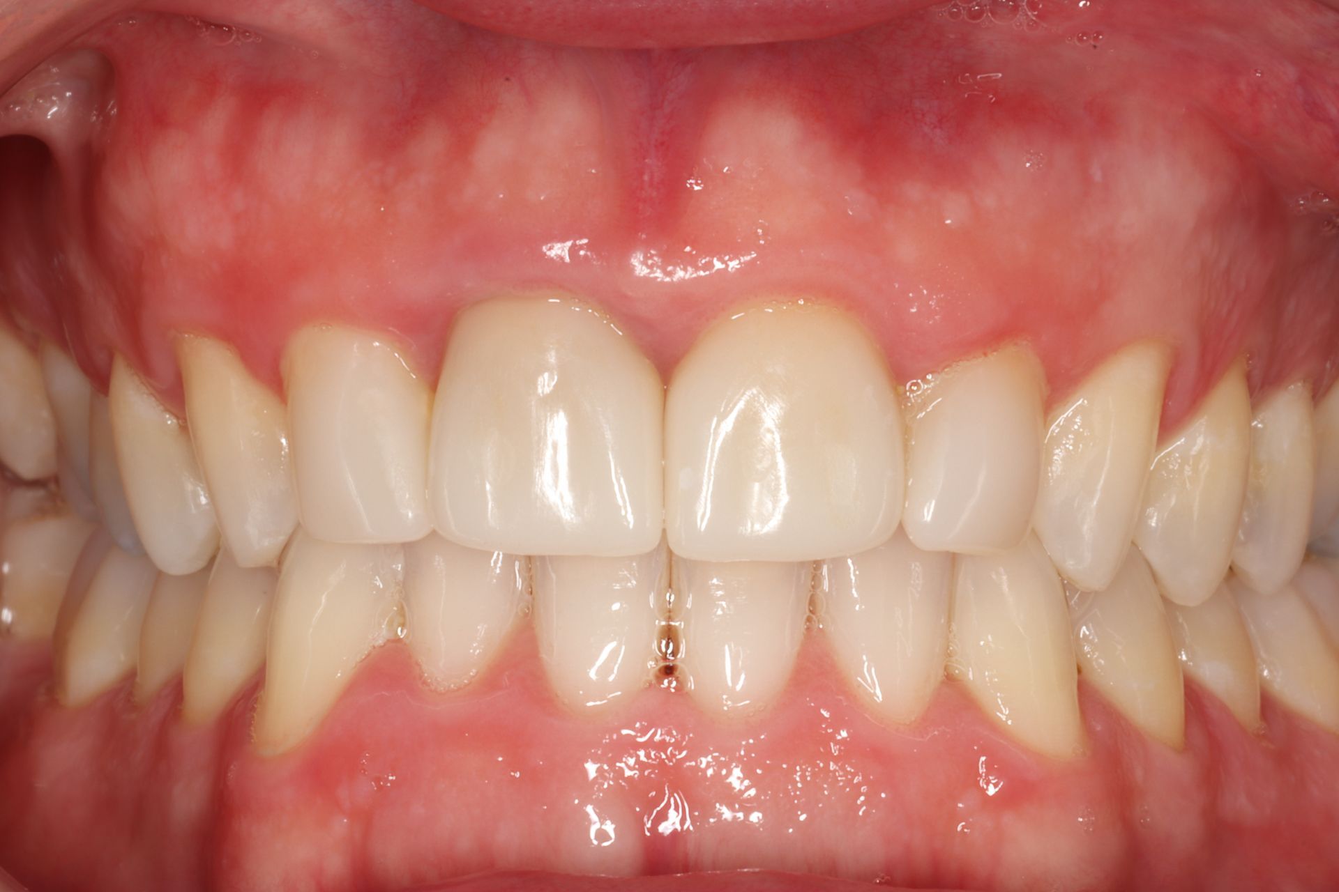 Full mouth makeover after