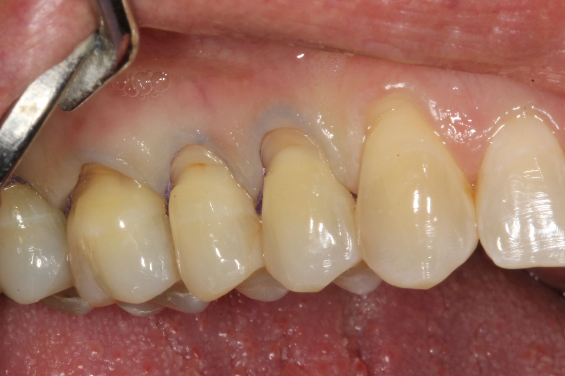 Veneers for an even smile before