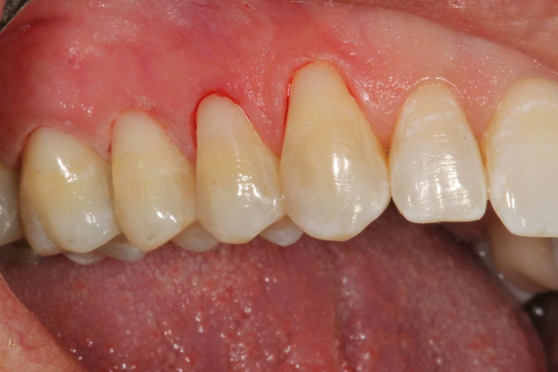 Veneers for an even smile after