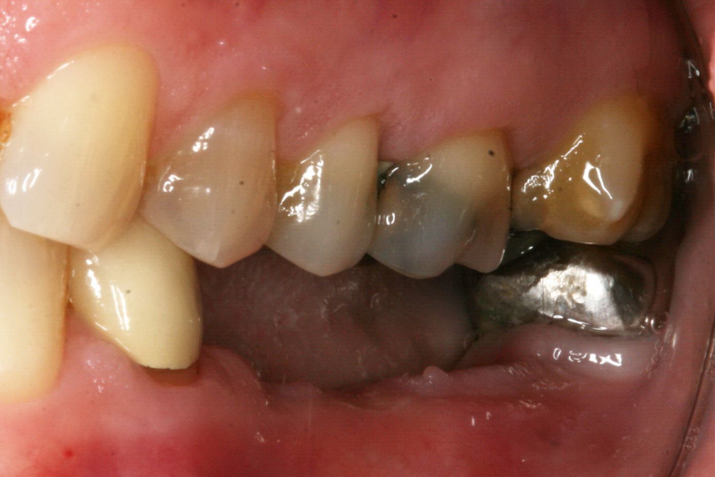 Fixing a decayed smile before