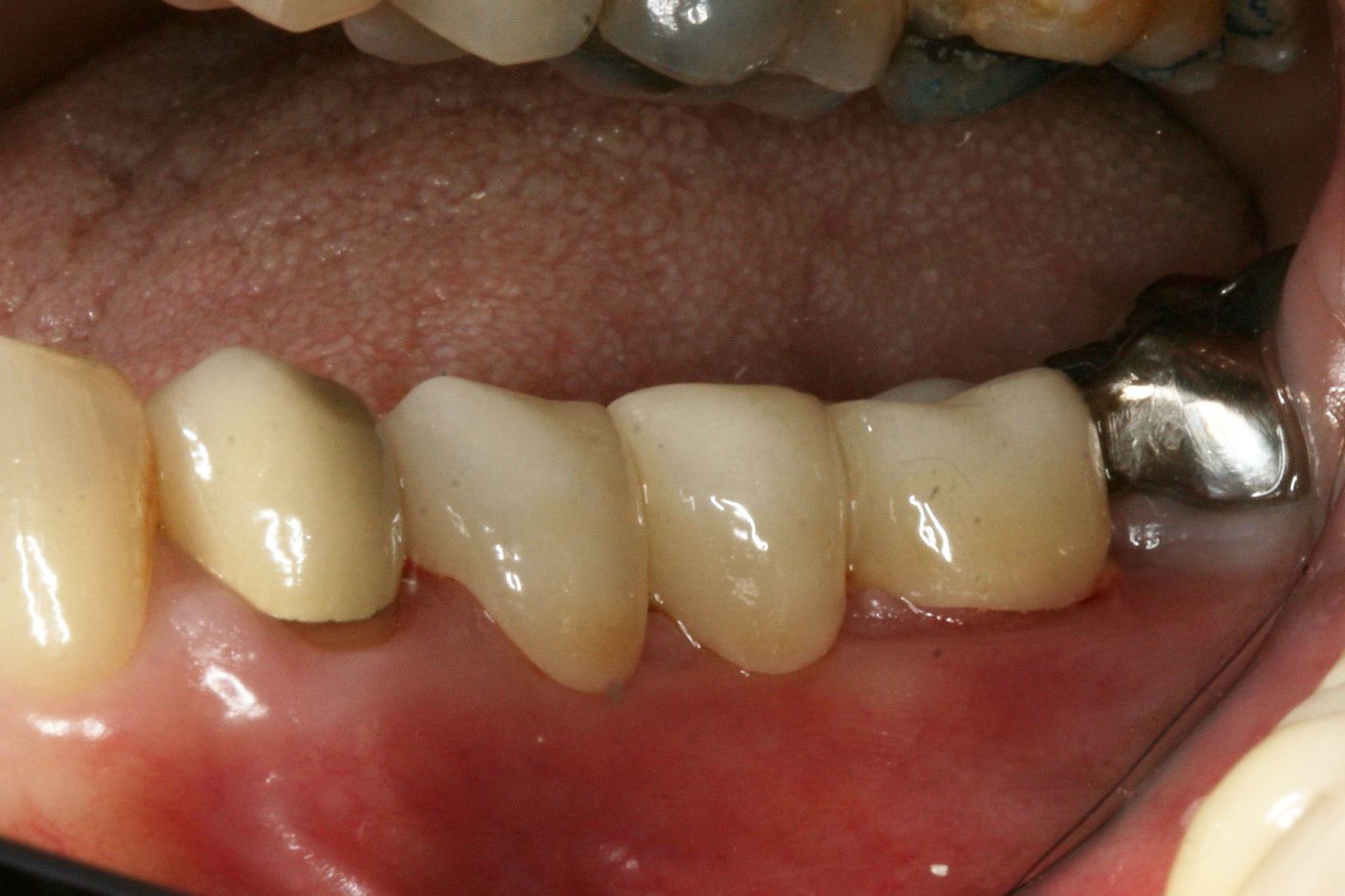 Fixing a decayed smile after