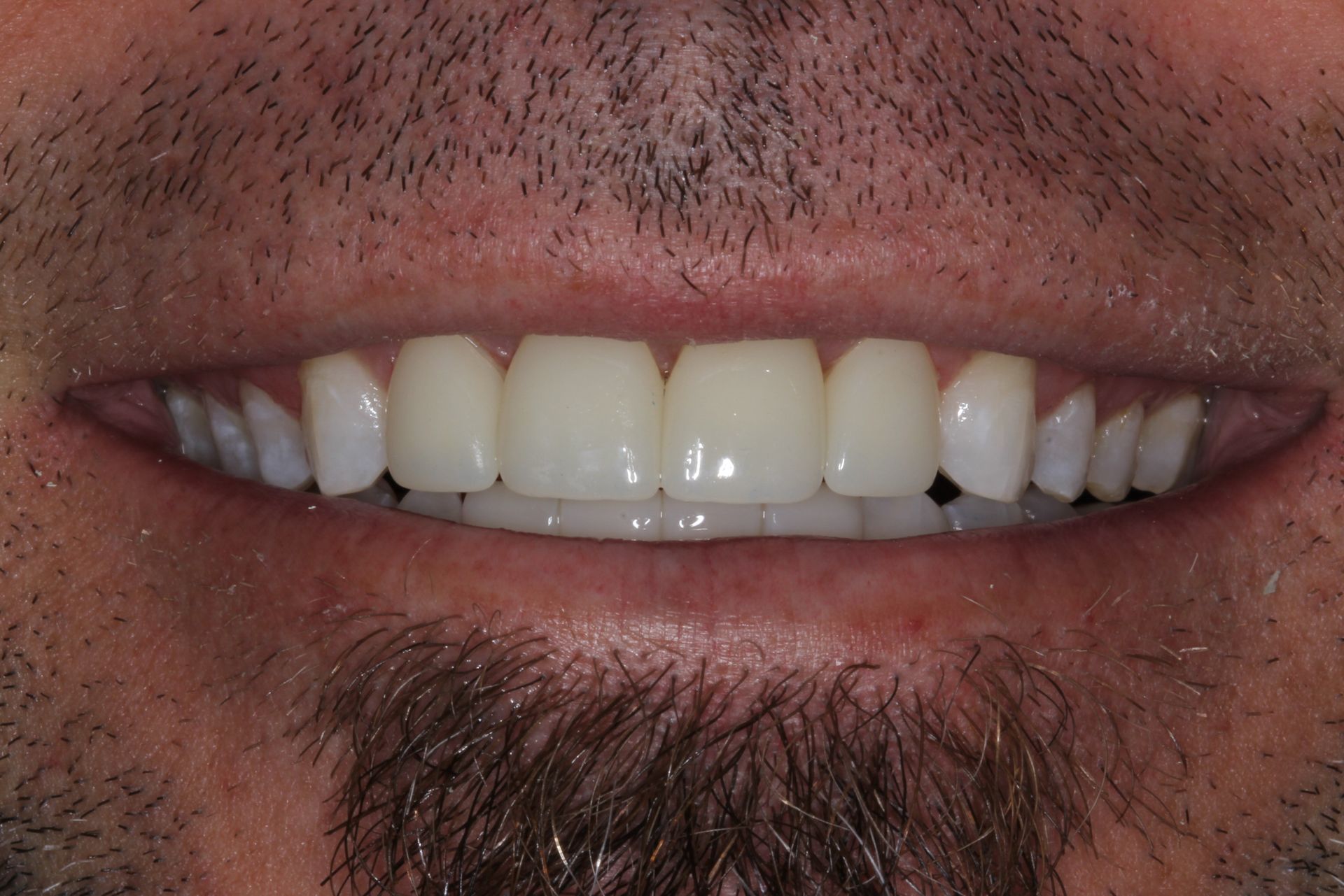 Veneers for an even smile after
