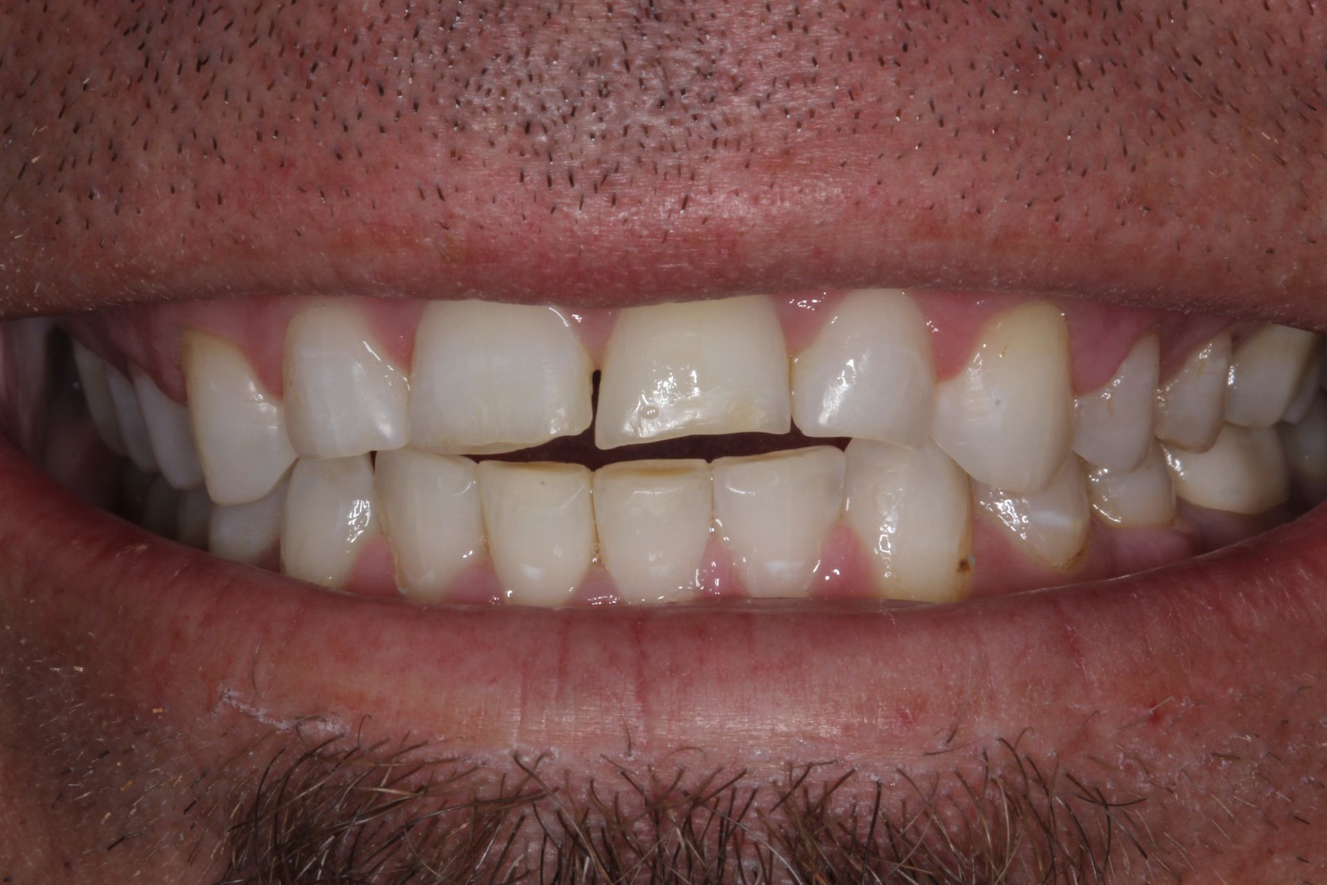 Veneers for an even smile before