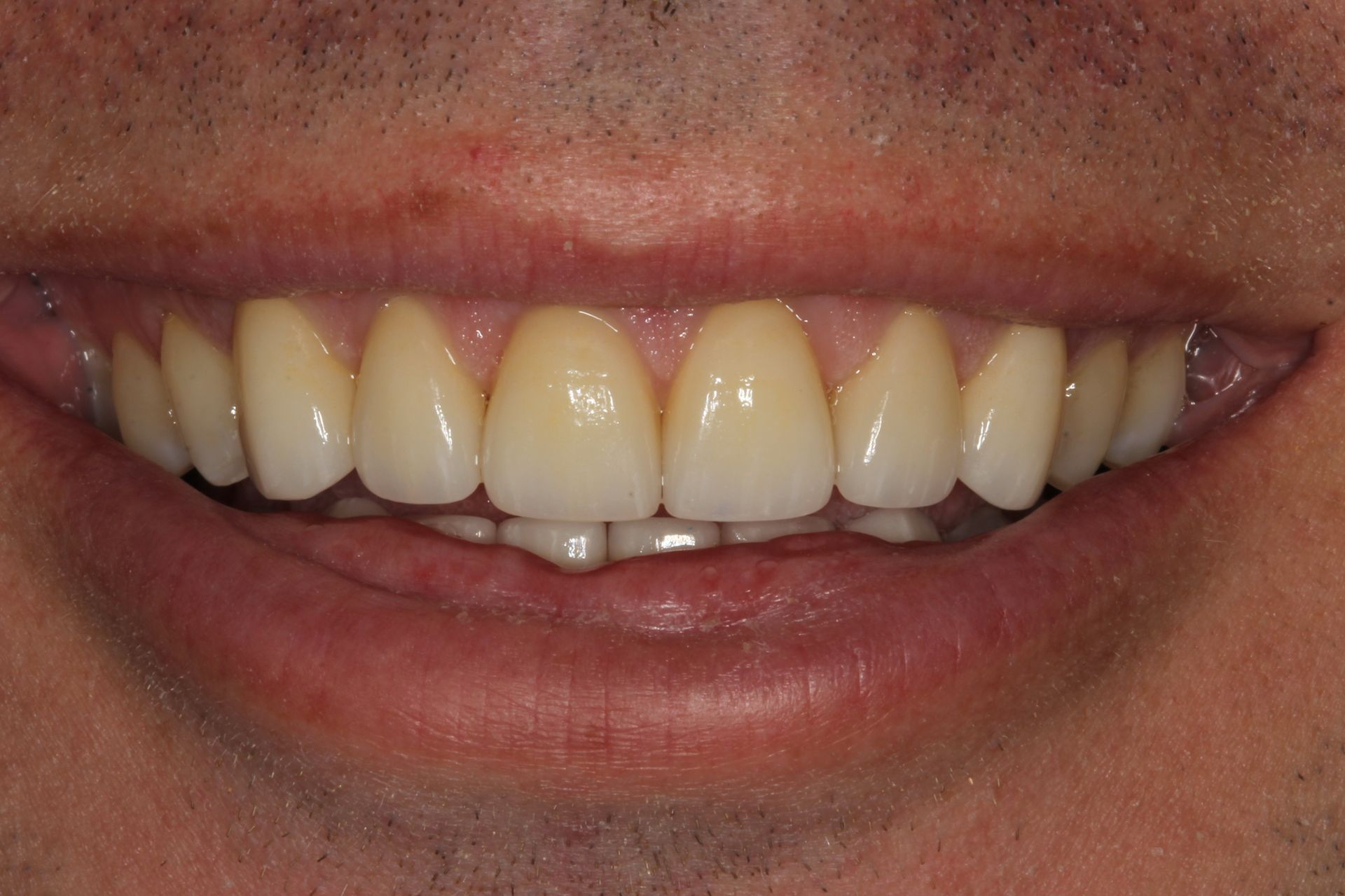 Full mouth makeover after