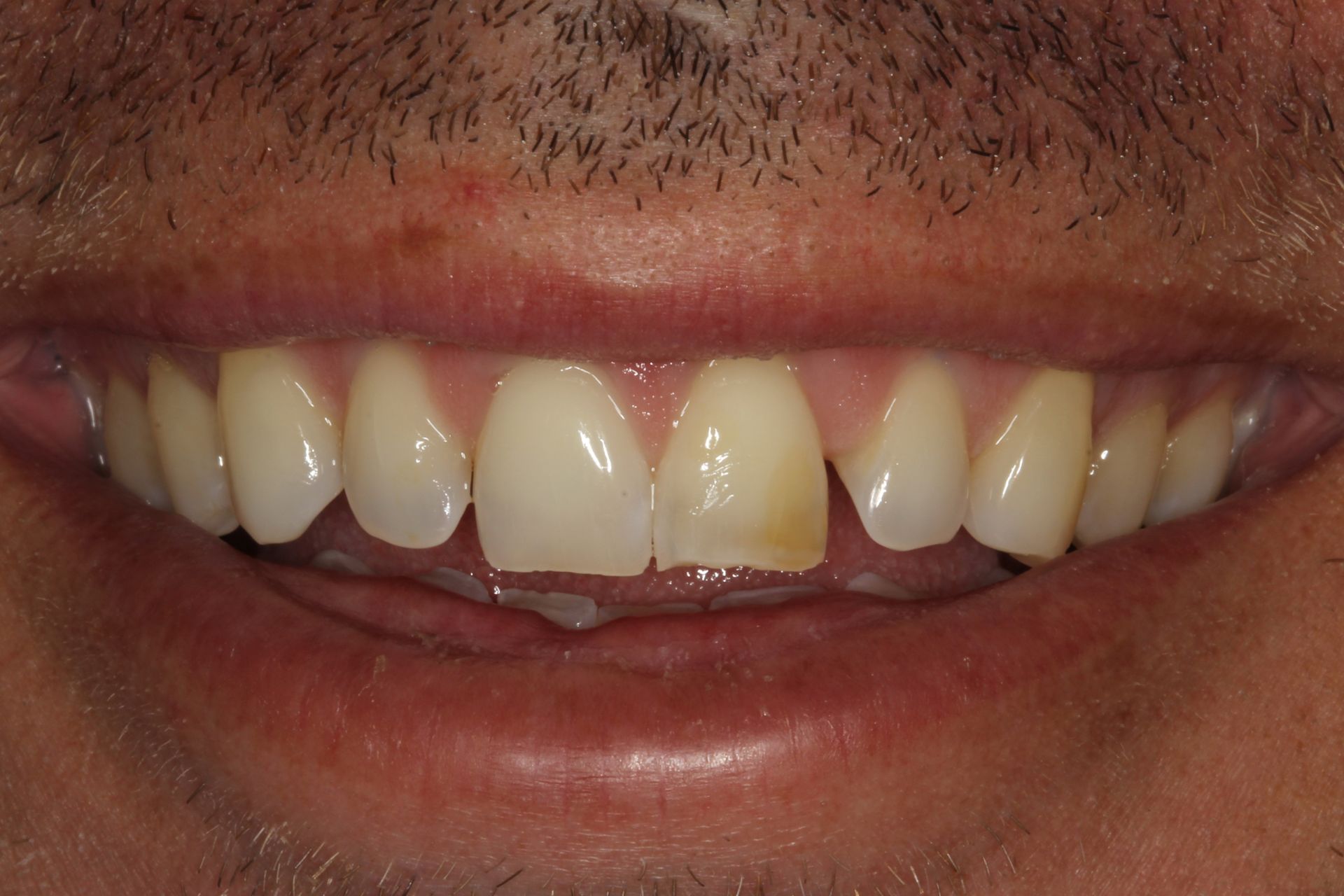 Full mouth makeover before