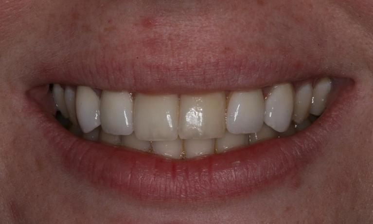 Veneers for an even smile after