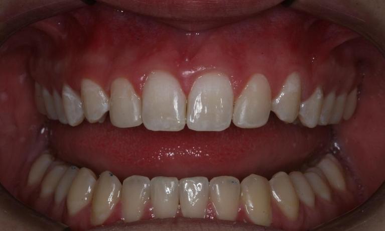 Short incisor teeth after