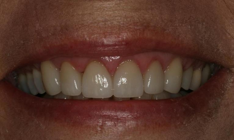 Smile worn down by grinding after