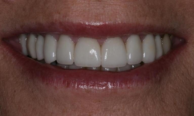 Full mouth makeover after