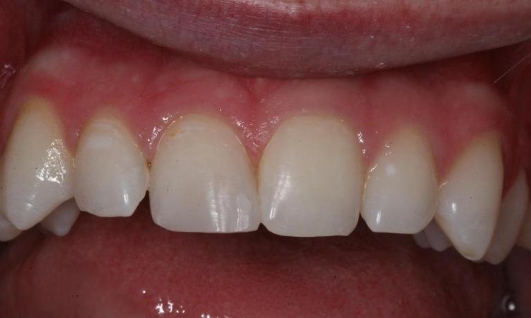 Tooth chipped by a hammer after