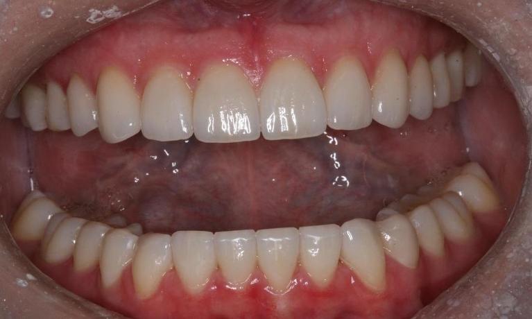 Repairing short teeth after