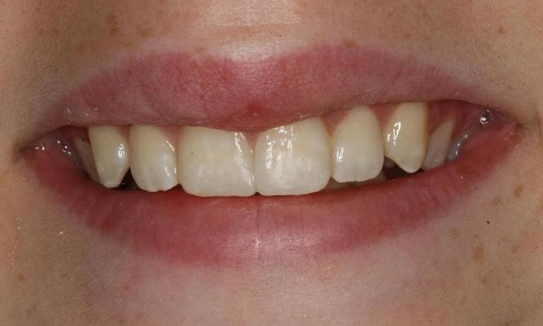 Two chipped front teeth after