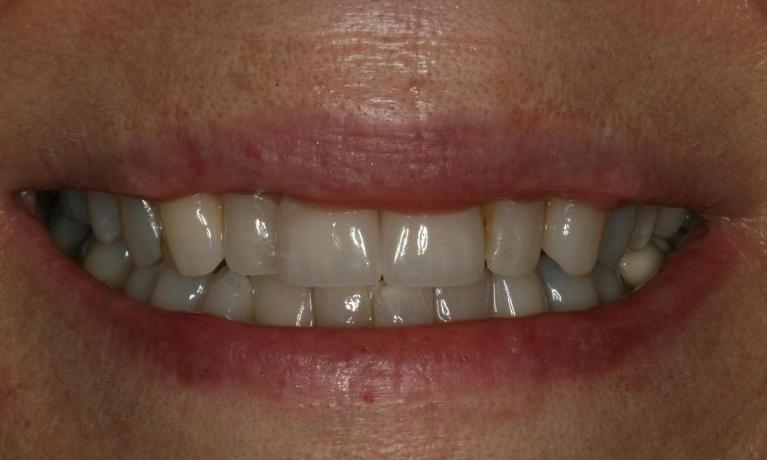 Porcelain crowns after