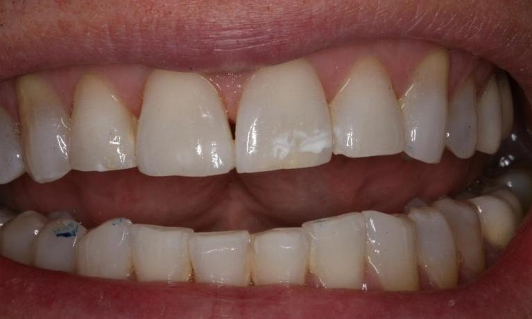 Chipped discolored tooth after