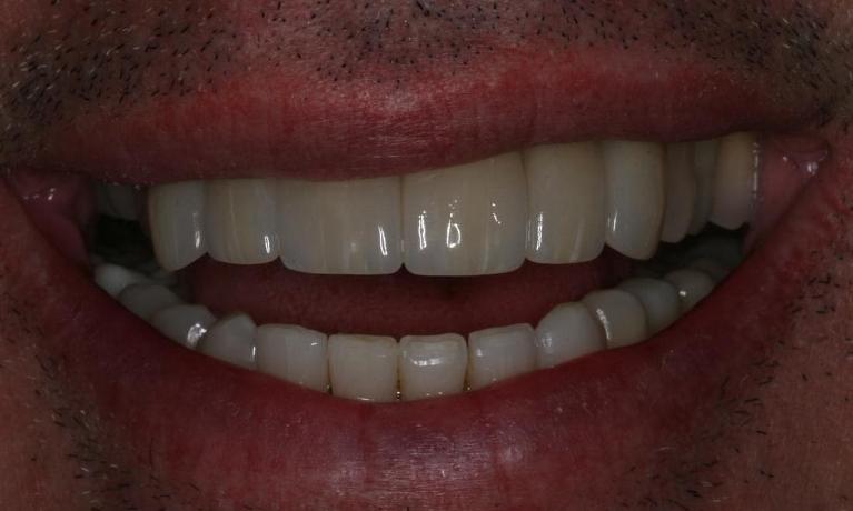 Fixing a decayed smile after