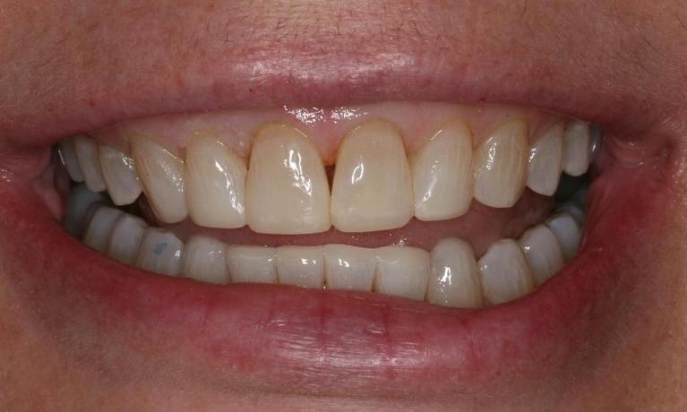 Worn down teeth from grinding after