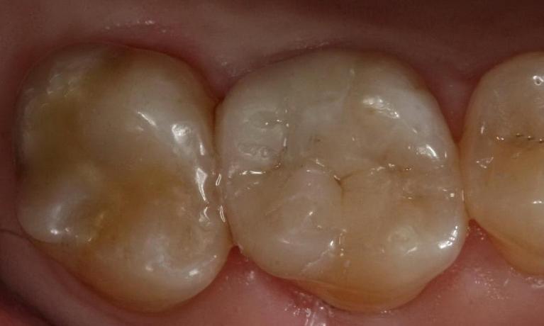 Replacing silver crowns after