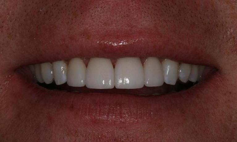 Veneers to close gaps after