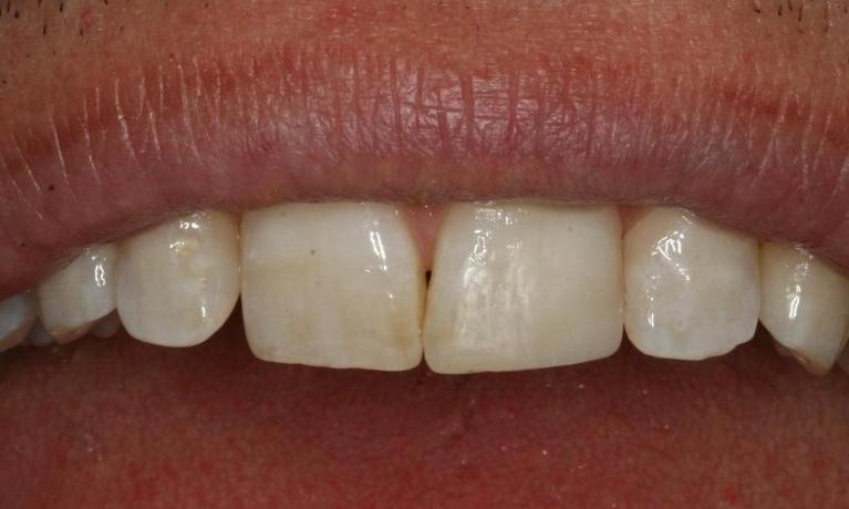 Repairing a chipped tooth after