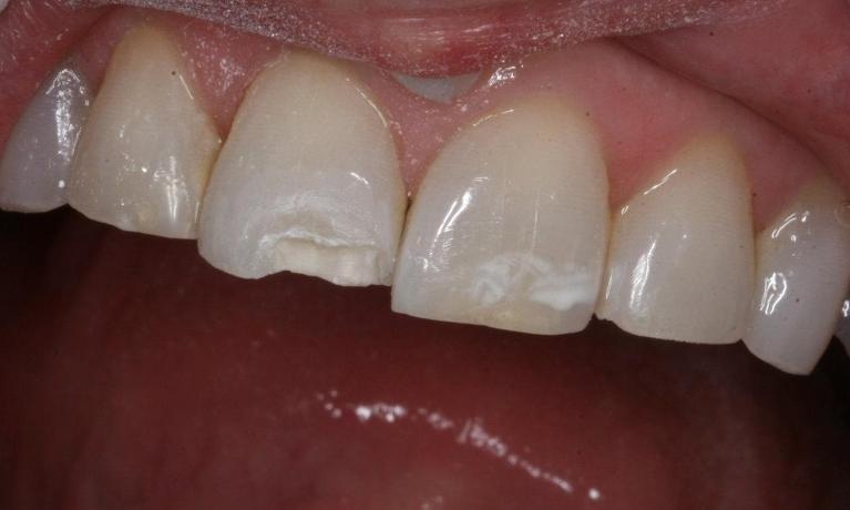 Chipped discolored tooth before