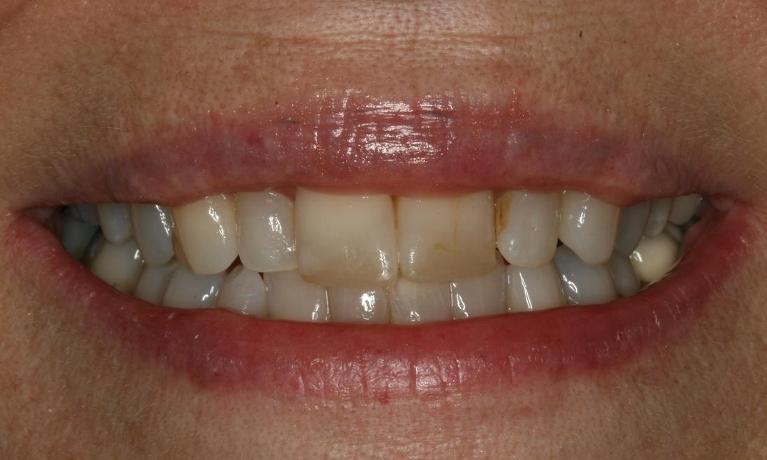 Porcelain crowns before