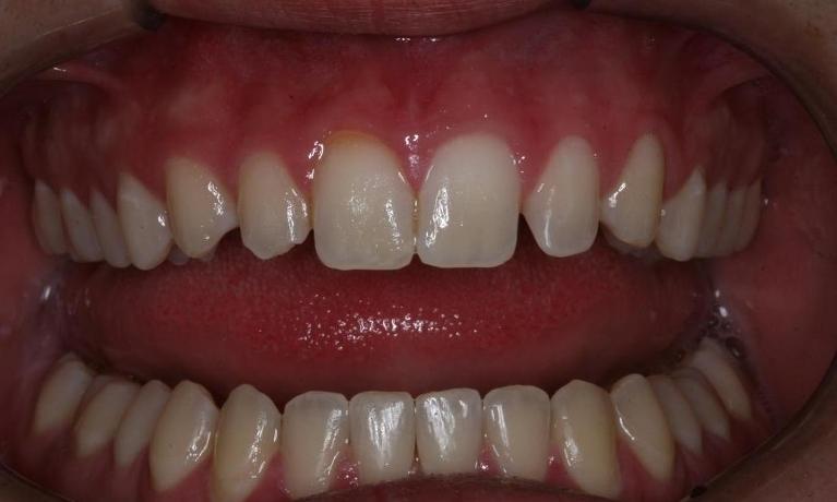 Short incisor teeth before