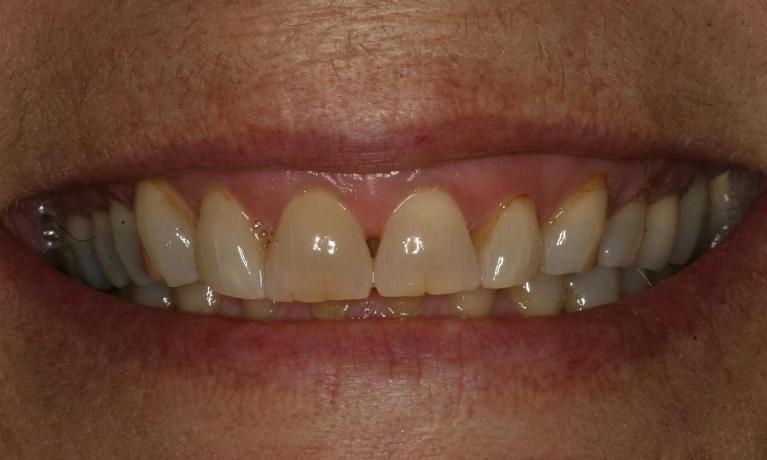 Smile worn down by grinding before