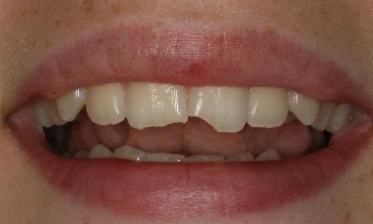 Two chipped front teeth before