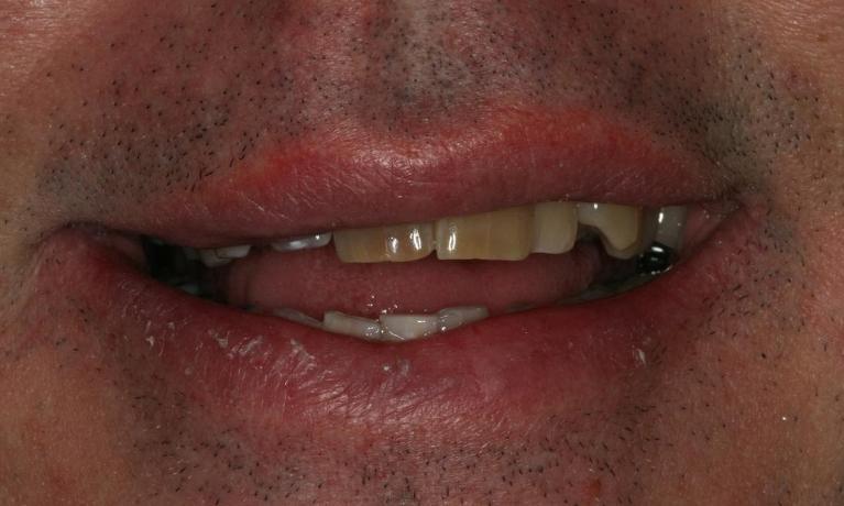 Fixing a decayed smile before