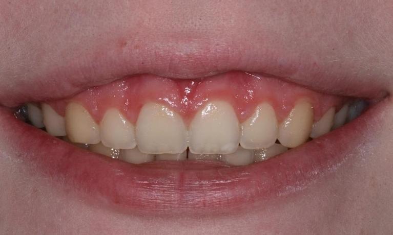 Gummy smile before