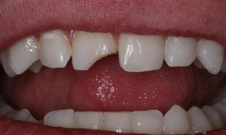 Tooth chipped by a hammer before