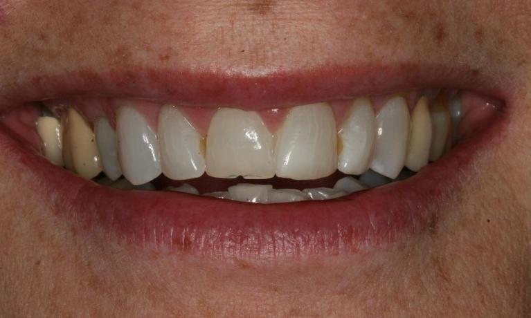 Full mouth makeover before