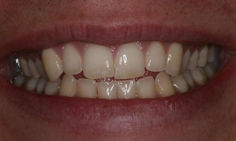 Crowded teeth before