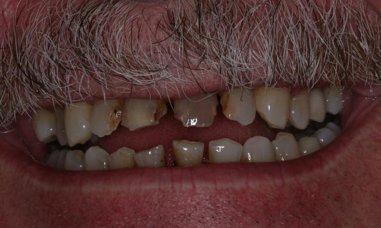 Crowns for a nervous patient before