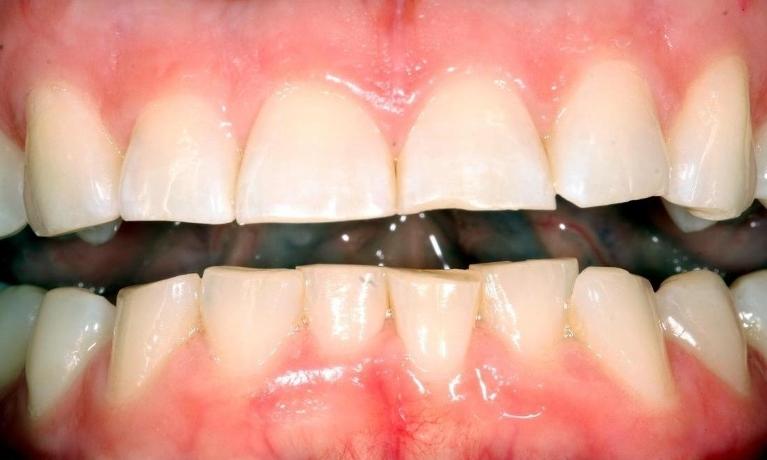Repairing short teeth before