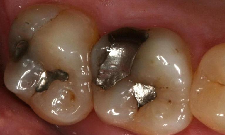 Replacing silver crowns before