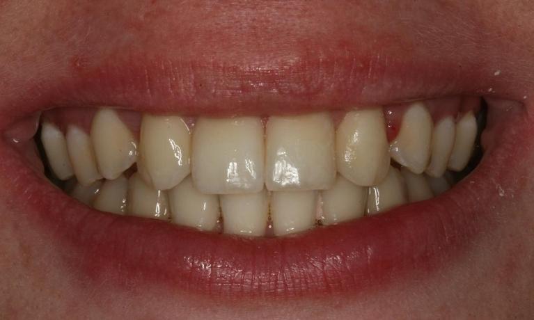 Veneers for an even smile before