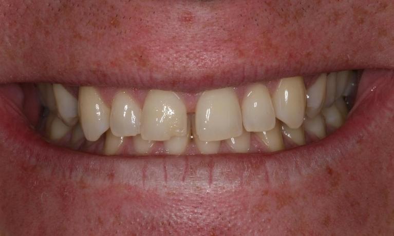Veneers to close gaps before