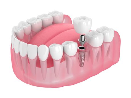 Single tooth dental implant