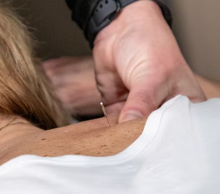 A patient undergoing dry needling treatment.
