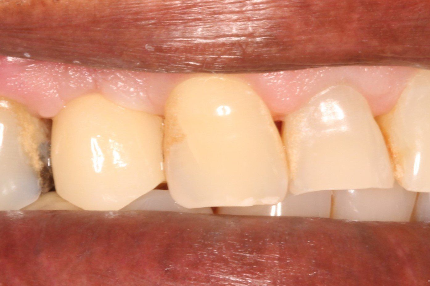 Our Before & After Smile Gallery Pall Mall Dental