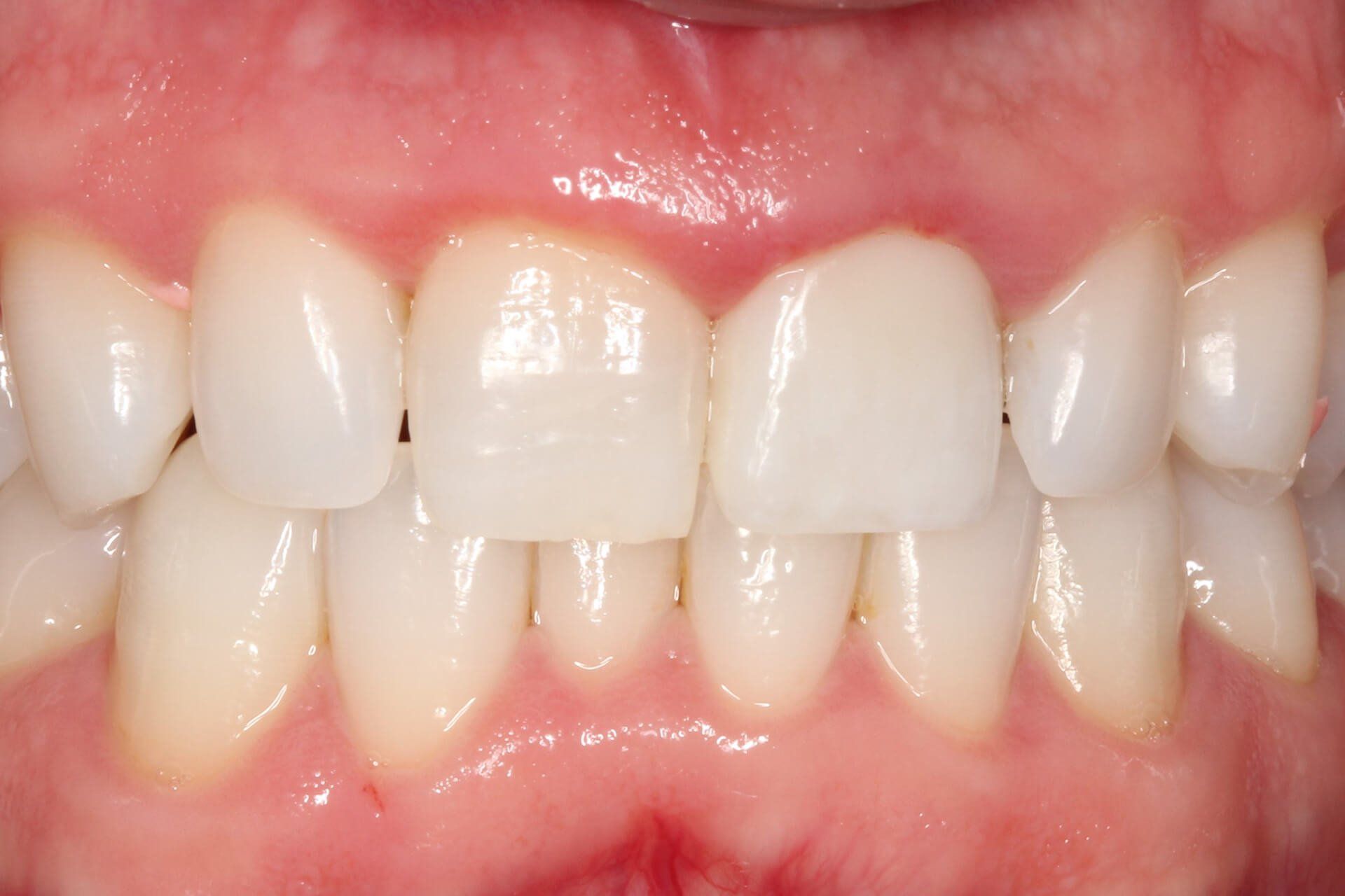 Our Before & After Smile Gallery Pall Mall Dental