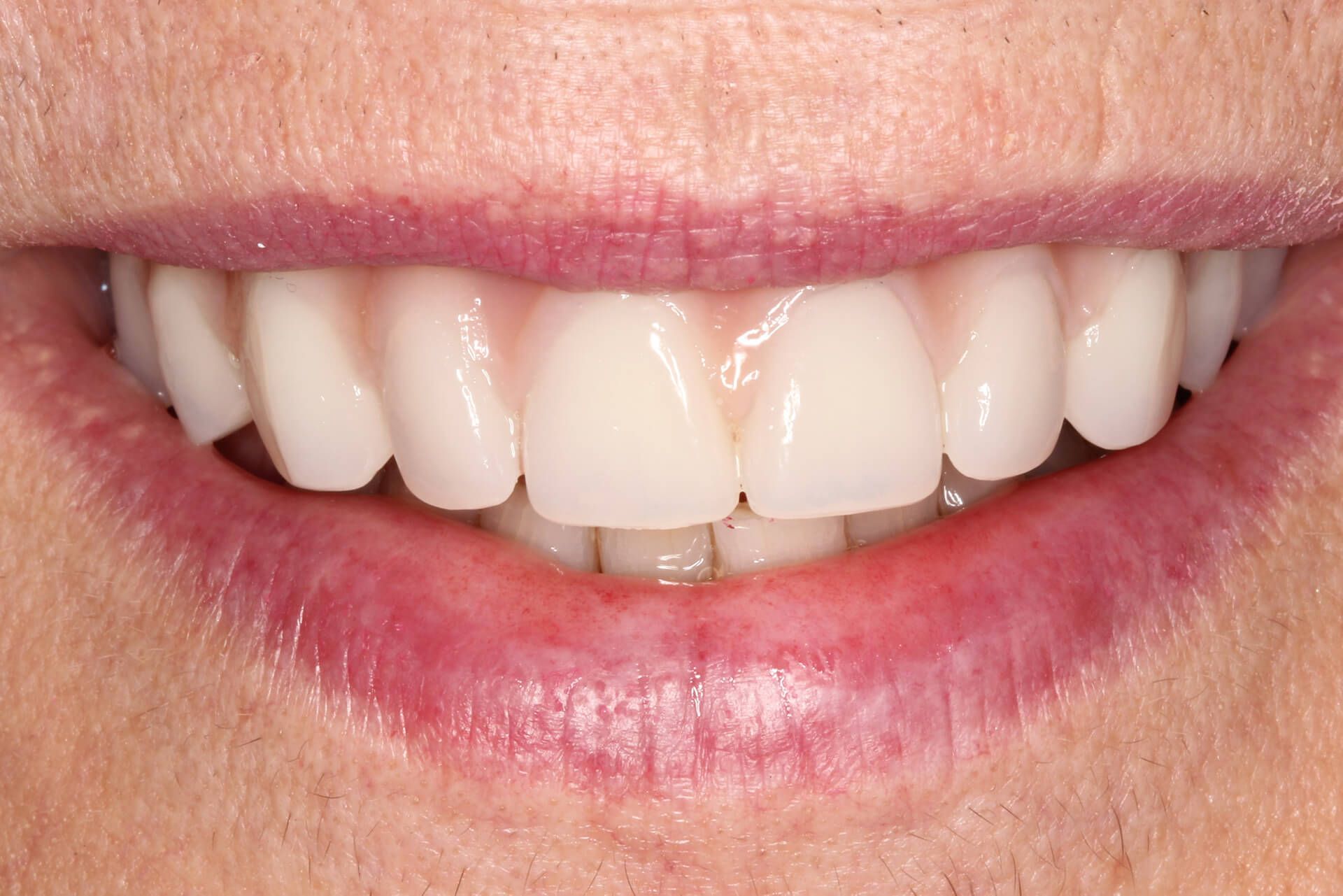 Our Before & After Smile Gallery Pall Mall Dental