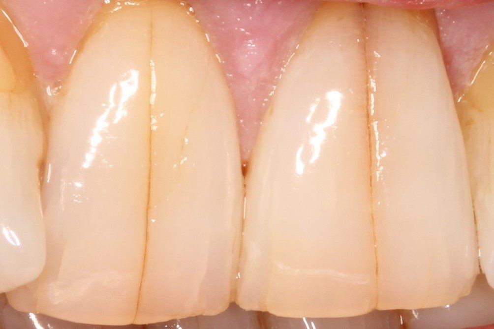 Our Before & After Smile Gallery Pall Mall Dental